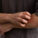 Dlaczego swędzi skóra? Najczęstsze przyczyny dyskomfortu osoba-zajmujaca-sie-tradzikiem-rozowatym-min