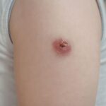 Jak przyspieszyć gojenie strupa