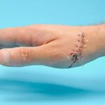 Etapy gojenia rany po szyciu