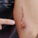 Dlaczego rana się nie goi