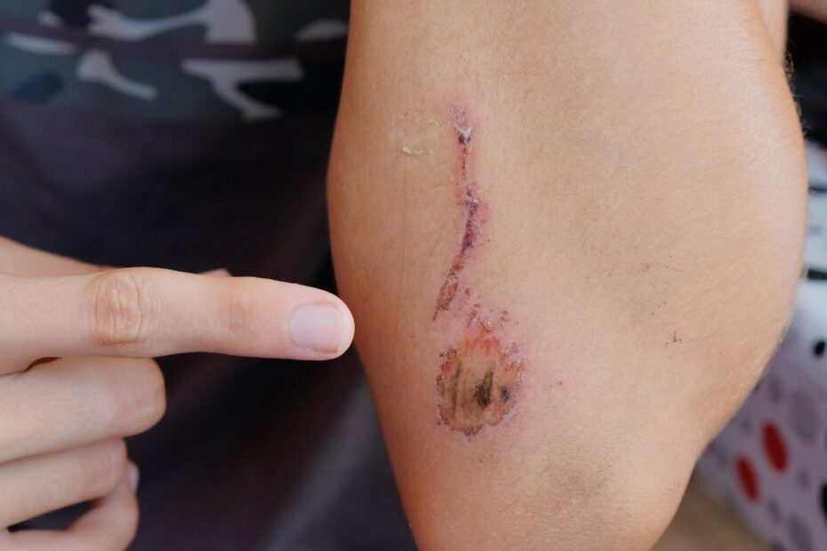 Dlaczego rana się nie goi