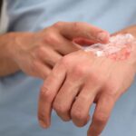 Domowe sposoby na gojenie ran – naturalne i skuteczne metody pielęgnacji Domowe sposoby na gojenie ran