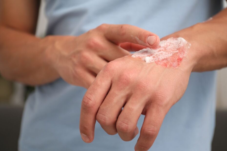 Domowe sposoby na gojenie ran