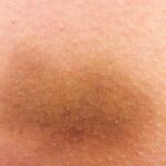 Jak przyspieszyć gojenie siniaka