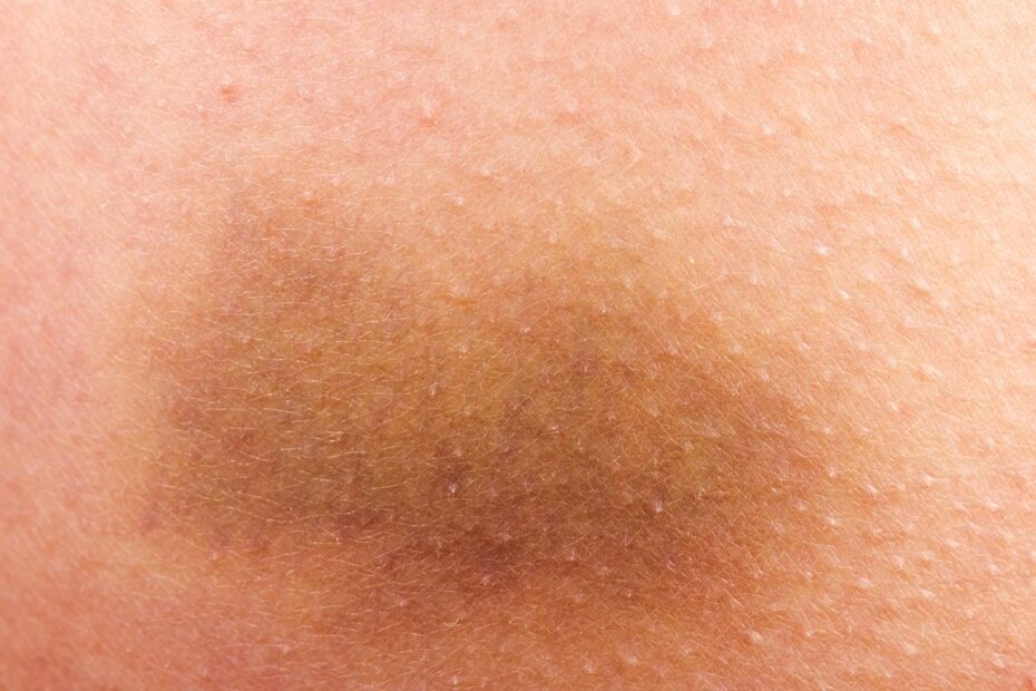 Jak przyspieszyć gojenie siniaka