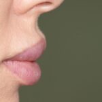 Jak długo goją się usta po kwasie