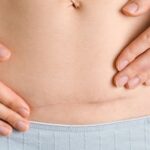 Etapy gojenia się rany po cesarce