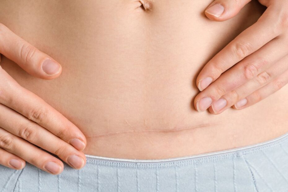 Etapy gojenia się rany po cesarce