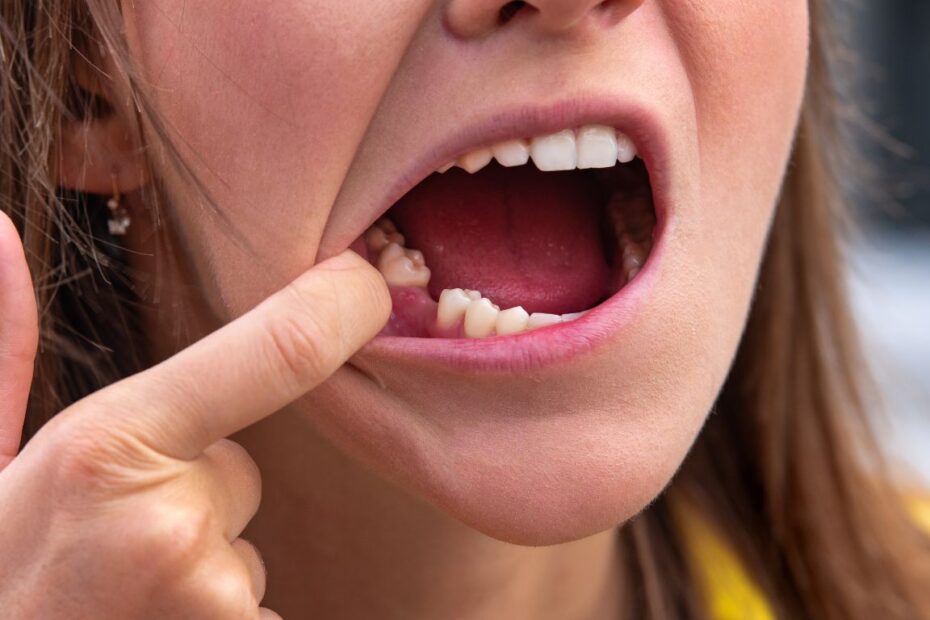 Ile goi się dziąsło po wyrwaniu zęba