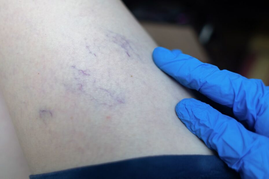 Jak długo goi się noga po skleroterapii