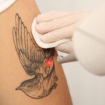 Usuwanie tatuażu gojenie