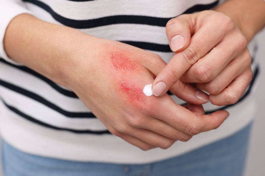 Maści na trudno gojące się rany