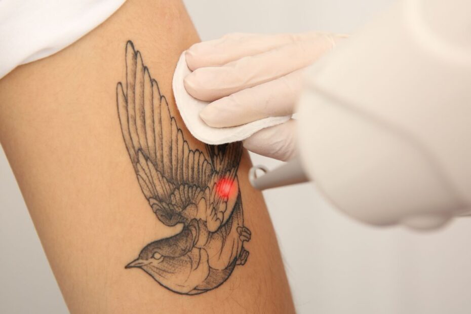 Usuwanie tatuażu gojenie