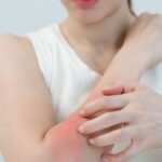 Zdarta skóra ile się goi