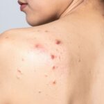 Gojenie rany po usunięciu kaszaka