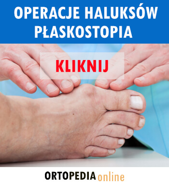 Operacje haluksów płaskostopia stopy